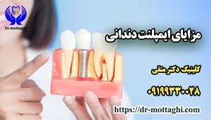 مزایای ایمپلنت دندانی